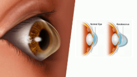 Corneal Cross-Linking West Palm Beach | Keratoconus Port St. Lucie