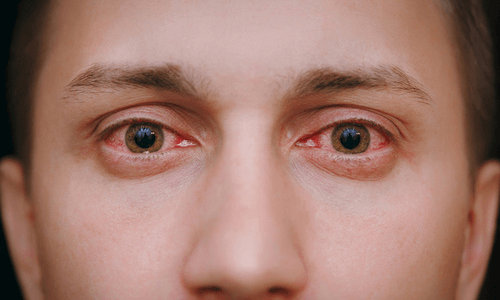 Puffy Eyes: Definition, Causes, Symptoms, and Treatment